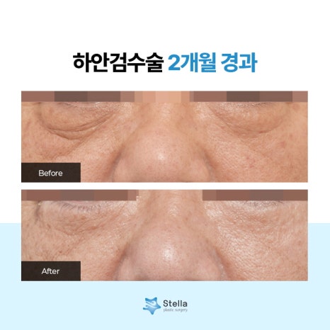 눈 수술 후, 빠른회복을 위한 방법은 ??  스텔라가 알려드릴게요!  (오목교 스텔라성형외과) 관련 이미지 6