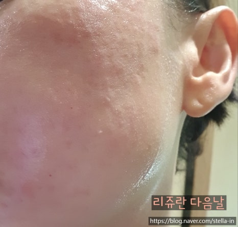 목동 (오목교) 입소문 난 리쥬란주사 회복기간? 관련 이미지 6
