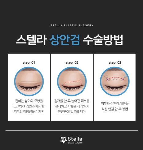 눈 수술 후, 빠른회복을 위한 방법은 ??  스텔라가 알려드릴게요!  (오목교 스텔라성형외과) 관련 이미지 11
