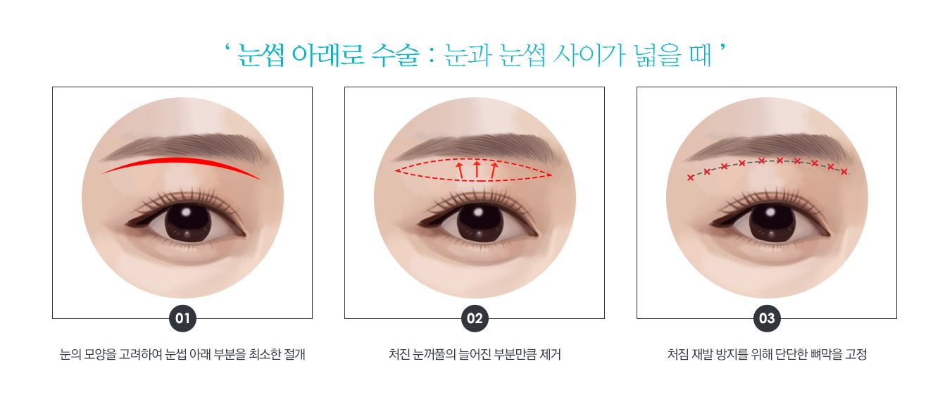 ★Mokdong/Yeongdeungpo/Omokgyo Stella Clinic: Solving Sagging Eyes That Make You Look Older, Brow Lift Under the Eyebrow!-1 (Surgical Method, Recommended Candidates) image 1