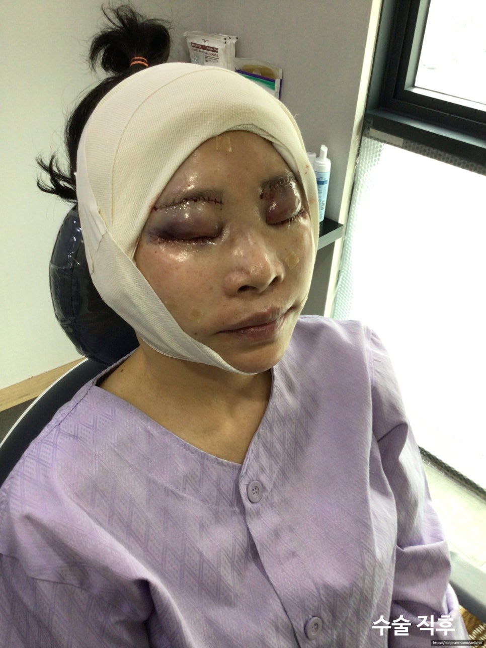 눈상담 받으러 왔다가 풀안면거상까지 하게된 60대중반 중년 어머님 (전/후) /목동 성형외과 스텔라성형 관련 이미지 11