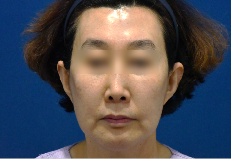 심부볼 처짐 해결 !! 화곡동 안면거상수술의 특별함은?(전/후사진) 관련 이미지 4