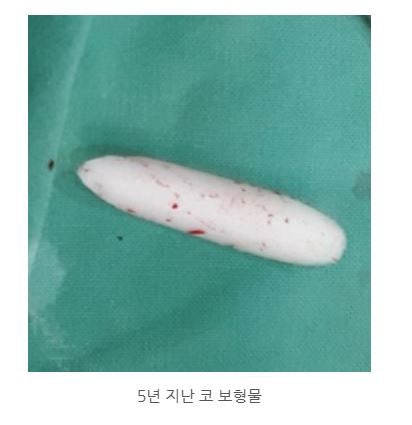 목동 성형외과 #코 보형물 제거 , 코 염증 현상 관련 이미지 3