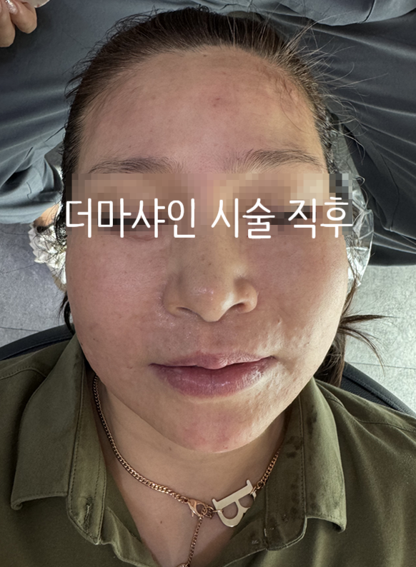 Mok-dong/Omok-gyo Stella Rejuran/Juvelook/Water Glow/Skin Botox: Why Does It Need to Be Properly Delivered into the Dermis During the Procedure? image 6