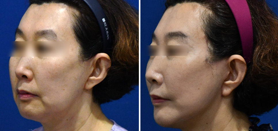 심부볼 처짐 해결 !! 화곡동 안면거상수술의 특별함은?(전/후사진) 관련 이미지 3