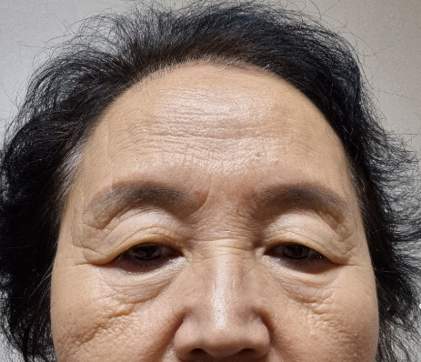 [오목교] 효도성형! 70대 어머님 ,스텔라의원에서 제 2의인생 다시시작하다! 관련 이미지 2