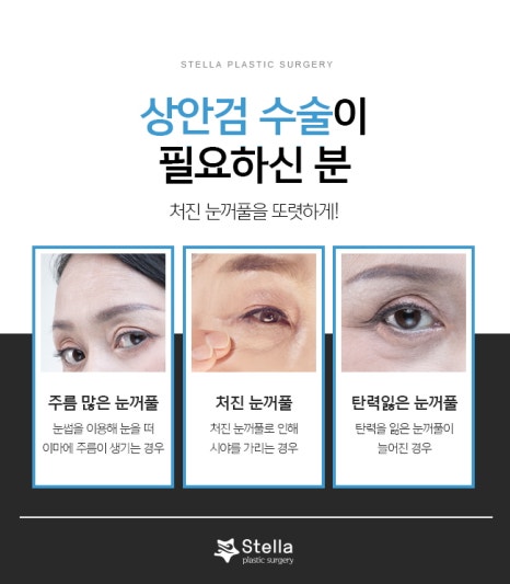 눈 수술 후, 빠른회복을 위한 방법은 ??  스텔라가 알려드릴게요!  (오목교 스텔라성형외과) 관련 이미지 2
