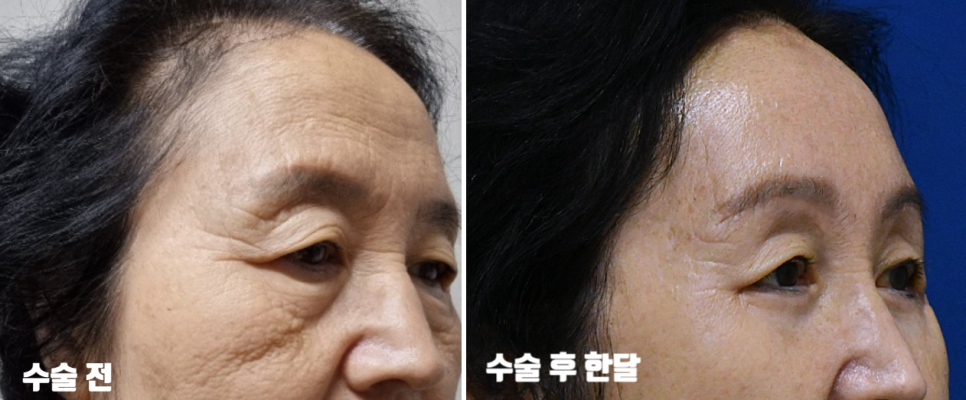 [오목교] 효도성형! 70대 어머님 ,스텔라의원에서 제 2의인생 다시시작하다! 관련 이미지 11