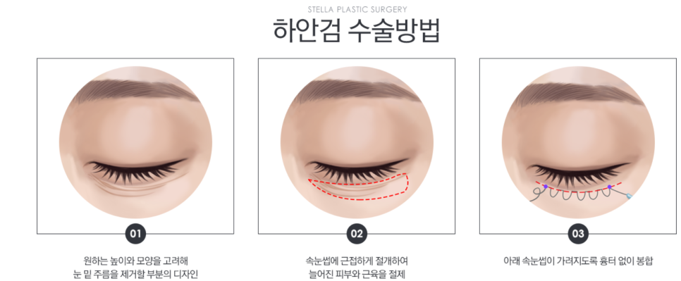 목동 성형외과/오목교 스텔라의원 50대 하안검 수술 회복기간?<리얼사진있습니다!> 관련 이미지 2