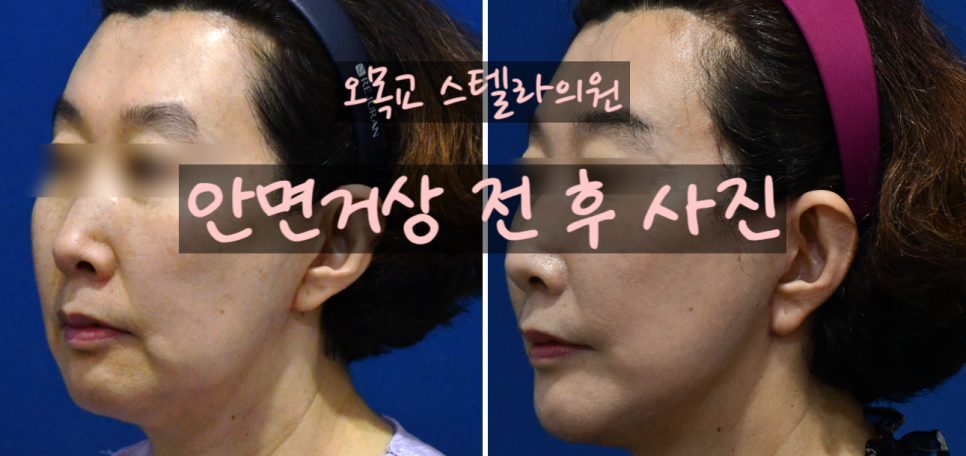 심부볼 처짐 해결 !! 화곡동 안면거상수술의 특별함은?(전/후사진) 관련 이미지 1