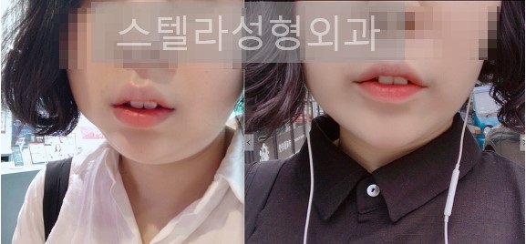 스텔라 성형외과 윤곽주사 관련 이미지 1