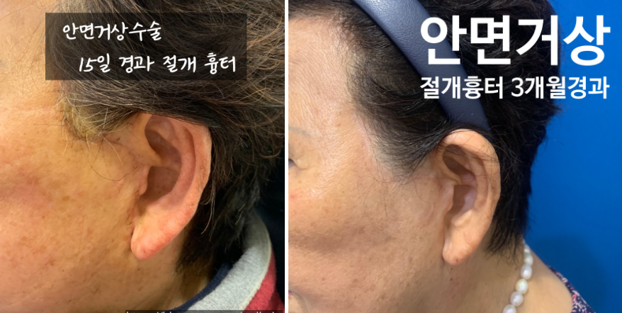 흔한 중년아빠의 안면거상 수술경과? 안면거상 많이하는 병원 관련 이미지 6