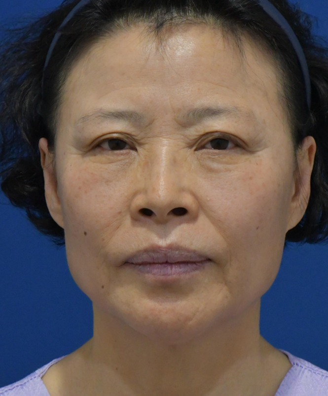 눈상담 받으러 왔다가 풀안면거상까지 하게된 60대중반 중년 어머님 (전/후) /목동 성형외과 스텔라성형 관련 이미지 1