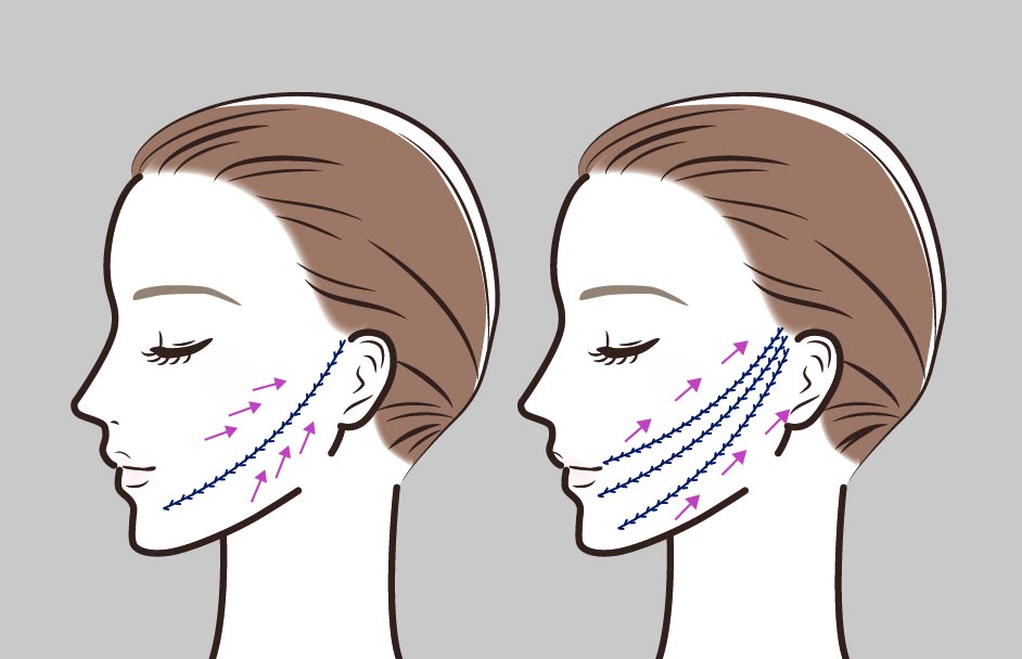 ★Mokdong/Yeongdeungpo/Omokgyo Stella Clinic Naturally Lifts the Skin~ Mint Thread Silhouette Lifting image 1
