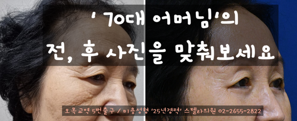 [오목교] 효도성형! 70대 어머님 ,스텔라의원에서 제 2의인생 다시시작하다! 관련 이미지 1