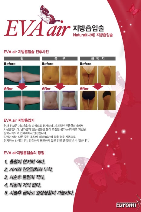 지방흡입하러 강남까지? 안전하게 대용량 흡입 + 빠른회복 ! ★ 수입장비 관련 이미지 3