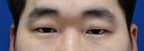 졸려보이는 눈, 안검하수란? 눈매교정에 대해서 알아보자! 관련 이미지 5