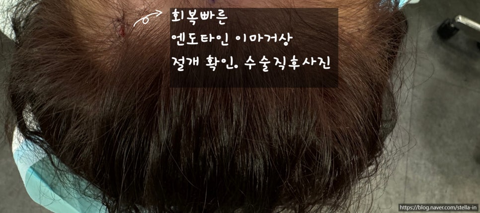 목동,화곡동,영등포 성형외과 /(눈성형) 이마거상 엔도타인 정품 확인하는방법 꿀팁! 필수 (수술직후 사진 有) 스텔라성형외과 관련 이미지 4