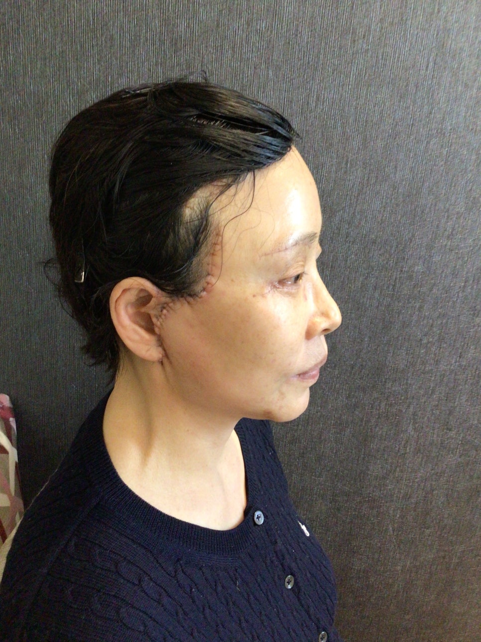 눈상담 받으러 왔다가 풀안면거상까지 하게된 60대중반 중년 어머님 (전/후) /목동 성형외과 스텔라성형 관련 이미지 21