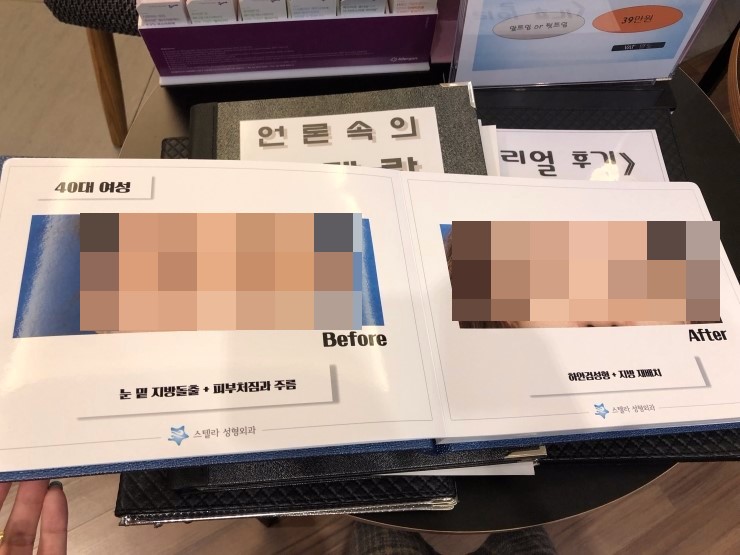 하안검 책자제작, 목동 성형외과 스텔라의원 관련 이미지 4