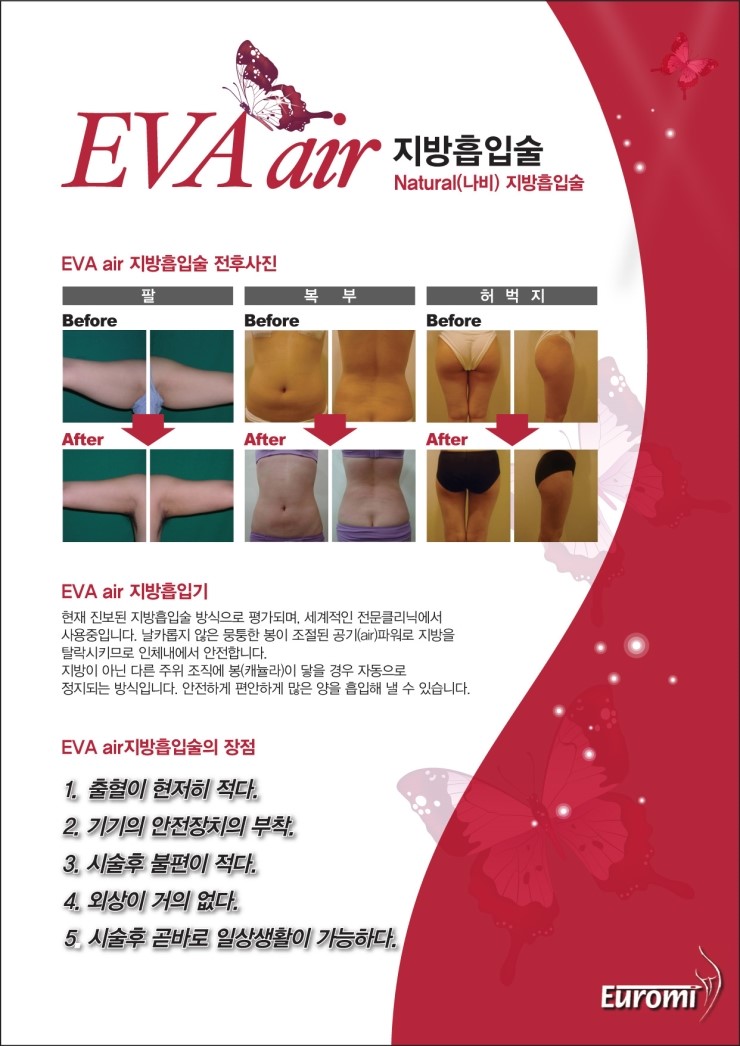 목동지방흡입은 스텔라에 맡기세요~ 관련 이미지 1