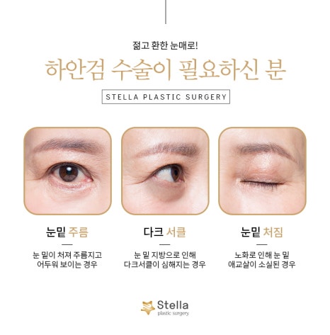 눈 수술 후, 빠른회복을 위한 방법은 ??  스텔라가 알려드릴게요!  (오목교 스텔라성형외과) 관련 이미지 3