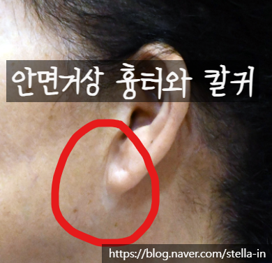목동 성형 스텔라 #안면거상 재수술 잘하는병원 #안면거상 절개흉터 제거 관련 이미지 7