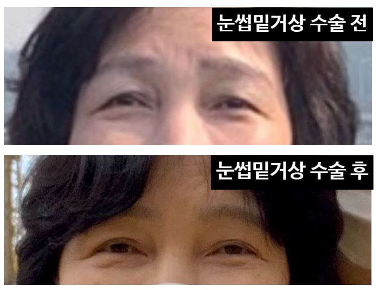 [오목교] 목동 성형외과 스텔라 직원 어머니 !! 60대 눈성형 (전/후) 관련 이미지 4