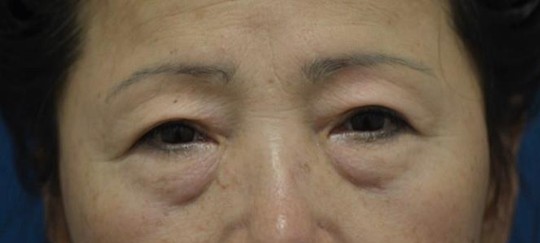 ★목동/영등포/오목교 스텔라의원 눈밑이 볼록해? 하안검지방재배치-1(수술 방법, 추천 대상) 관련 이미지 1