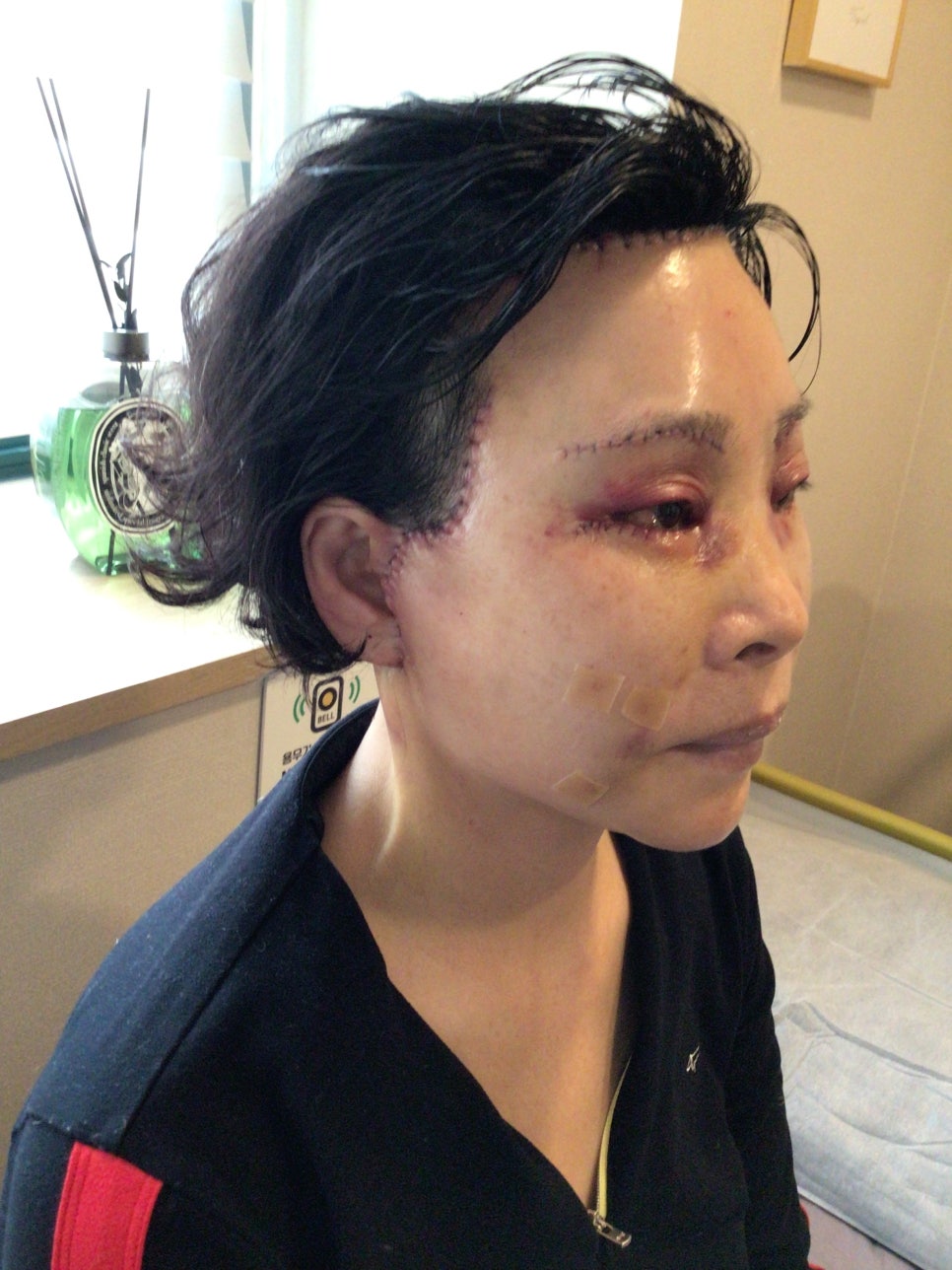 눈상담 받으러 왔다가 풀안면거상까지 하게된 60대중반 중년 어머님 (전/후) /목동 성형외과 스텔라성형 관련 이미지 14