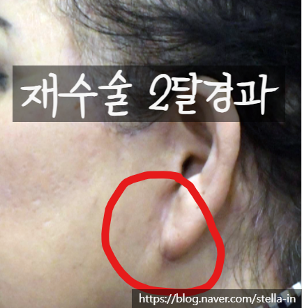 목동 성형 스텔라 #안면거상 재수술 잘하는병원 #안면거상 절개흉터 제거 관련 이미지 8