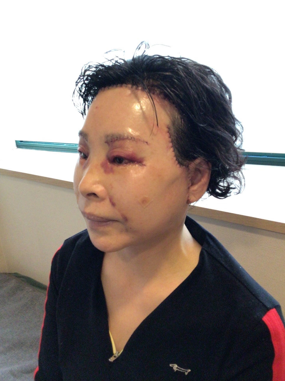 눈상담 받으러 왔다가 풀안면거상까지 하게된 60대중반 중년 어머님 (전/후) /목동 성형외과 스텔라성형 관련 이미지 15