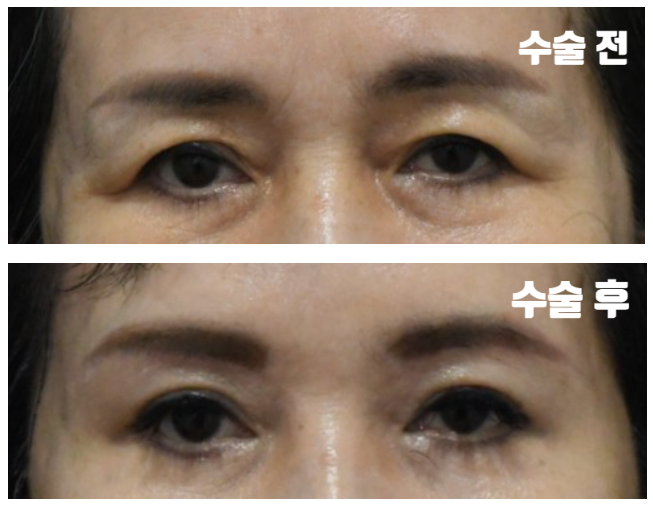 60대 눈처짐 수술후 인상이 강해보일까봐 걱정이라면? 관련 이미지 3