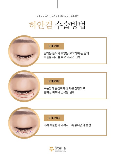 눈 수술 후, 빠른회복을 위한 방법은 ??  스텔라가 알려드릴게요!  (오목교 스텔라성형외과) 관련 이미지 12