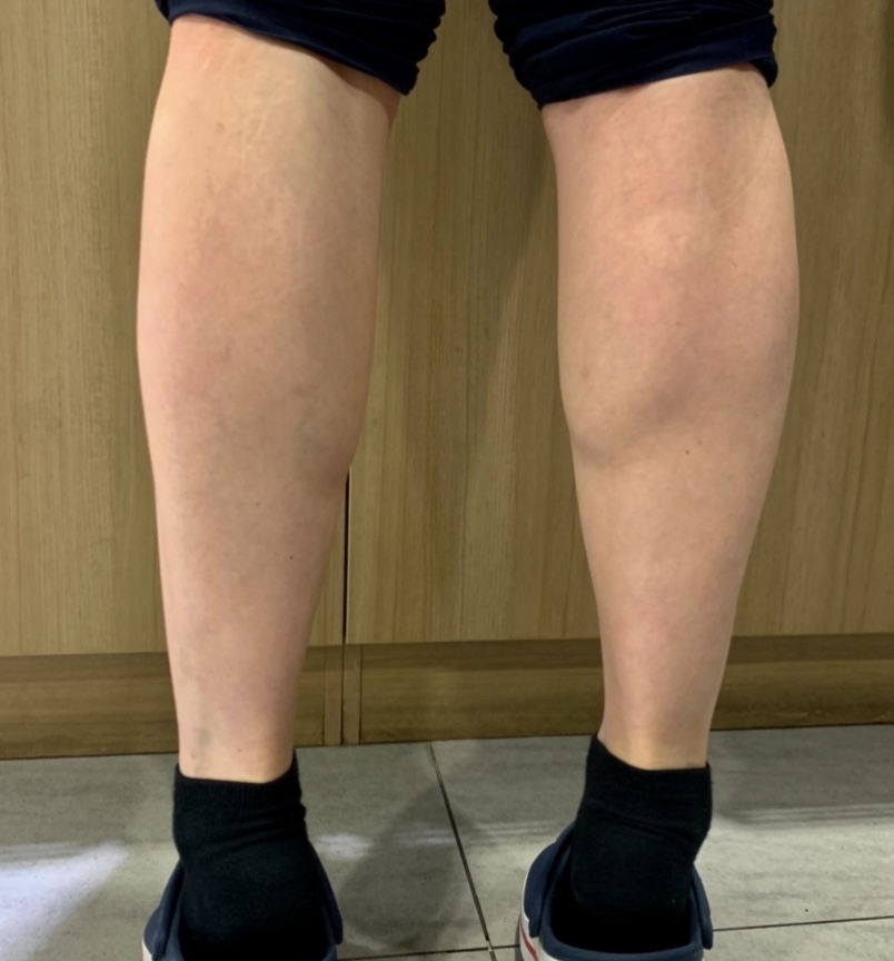 종아리 보톡스 잘하는곳 (직원후기)/나보타보톡스 관련 이미지 1
