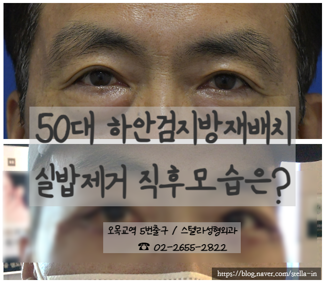 강서구/ 목동 성형외과 50대 남성 눈밑지방재배치 하안검 실밥제거 직후 회복과정 리얼 (전/후) 관련 이미지 1