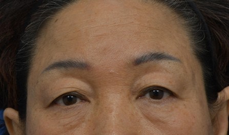 ★Mokdong/Yeongdeungpo/Omokgyo Stella Clinic: Solving Sagging Eyes That Make You Look Older, Brow Lift Under the Eyebrow!-1 (Surgical Method, Recommended Candidates) image 2