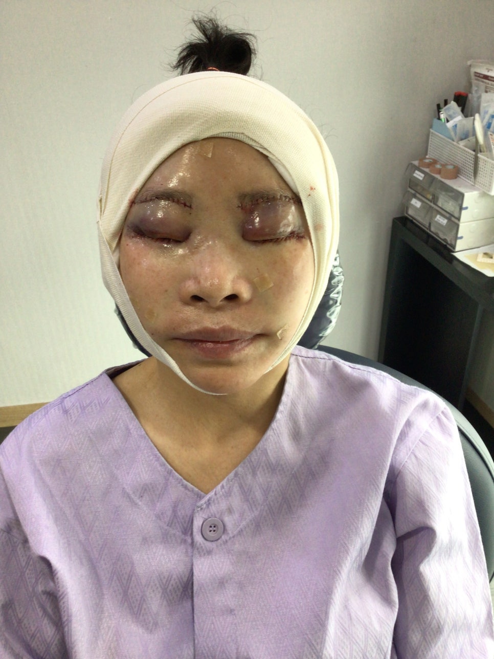 눈상담 받으러 왔다가 풀안면거상까지 하게된 60대중반 중년 어머님 (전/후) /목동 성형외과 스텔라성형 관련 이미지 12