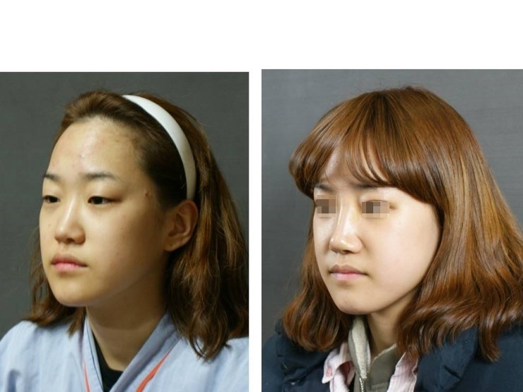 눈매교정은 목동스텔라 성형외과에서 관련 이미지 2