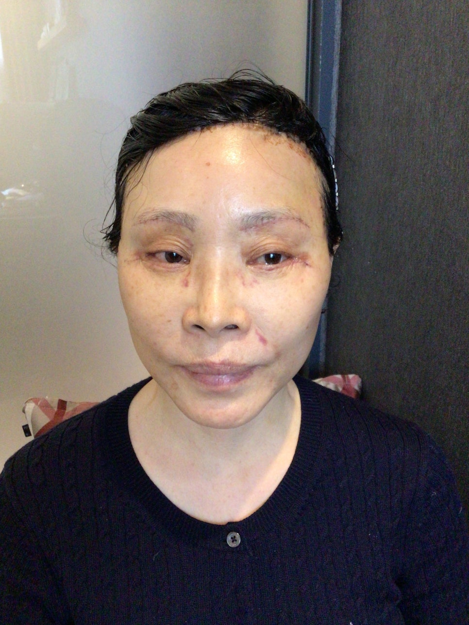 눈상담 받으러 왔다가 풀안면거상까지 하게된 60대중반 중년 어머님 (전/후) /목동 성형외과 스텔라성형 관련 이미지 20