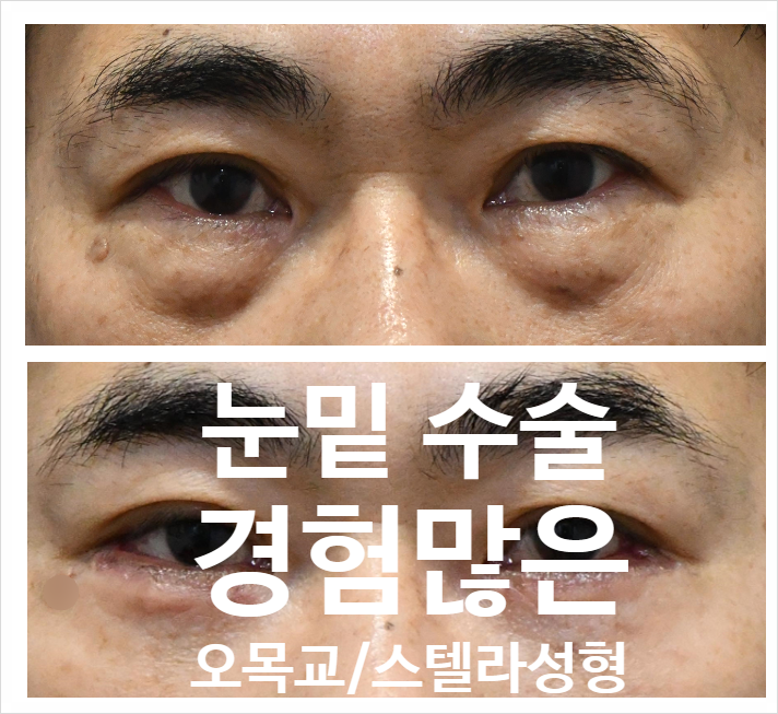 화곡동 성형 까치산 하안검 /하안검지방재배치 잘하는곳 (경험 많은 오목교 스텔라의원) 관련 이미지 2