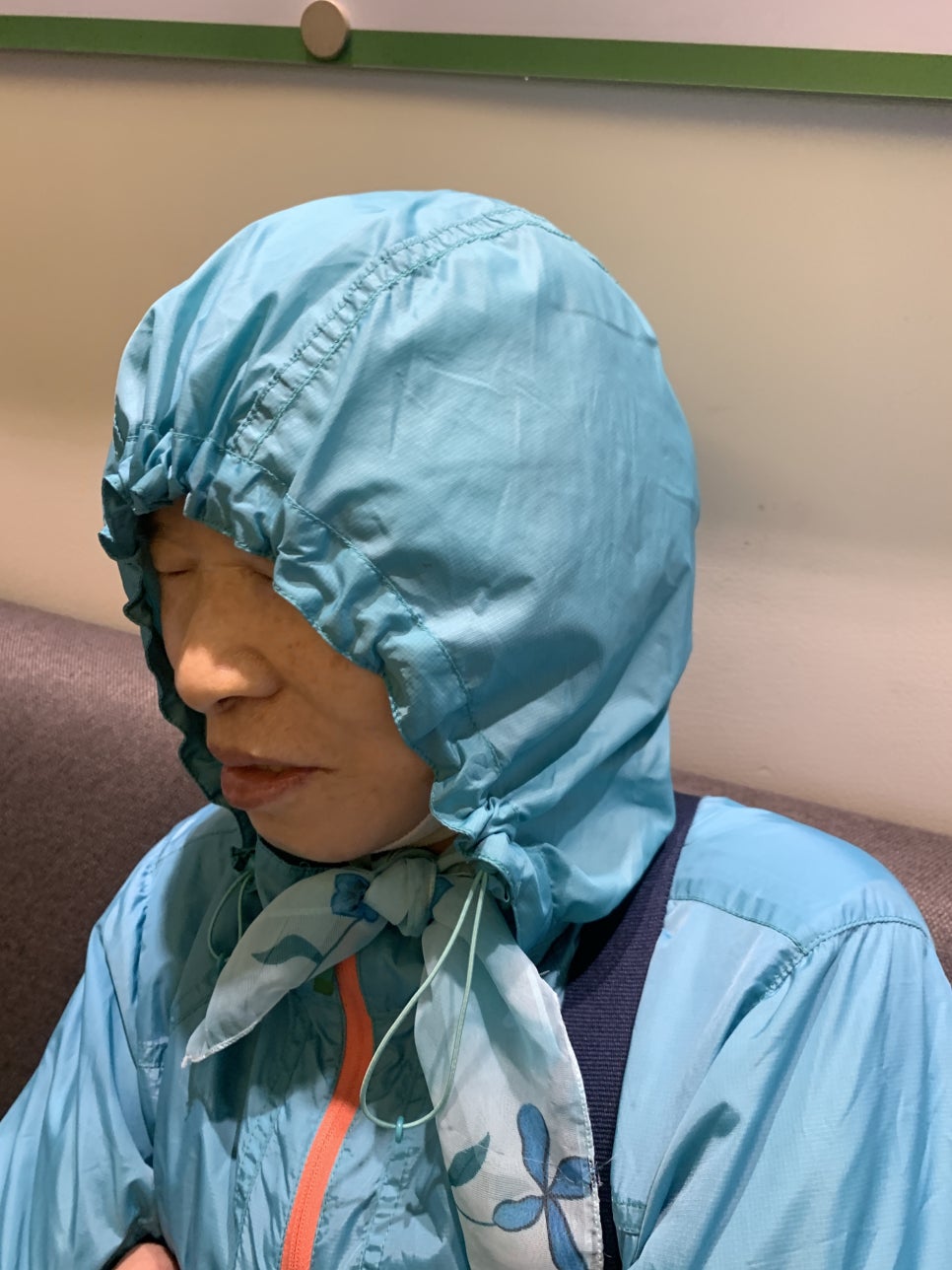 안면거상수술 과정 과 안면거상 회복기간 리얼영상 /오목교 스텔라 관련 이미지 4
