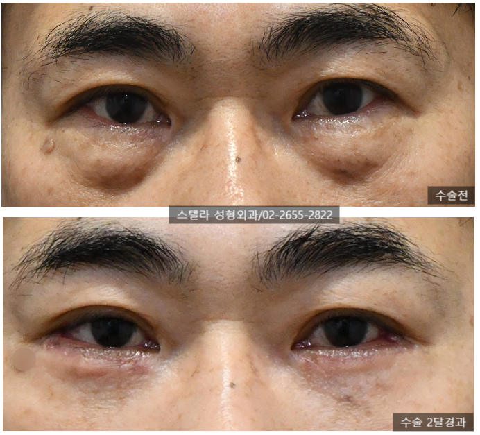 화곡동 성형 까치산 하안검 /하안검지방재배치 잘하는곳 (경험 많은 오목교 스텔라의원) 관련 이미지 4