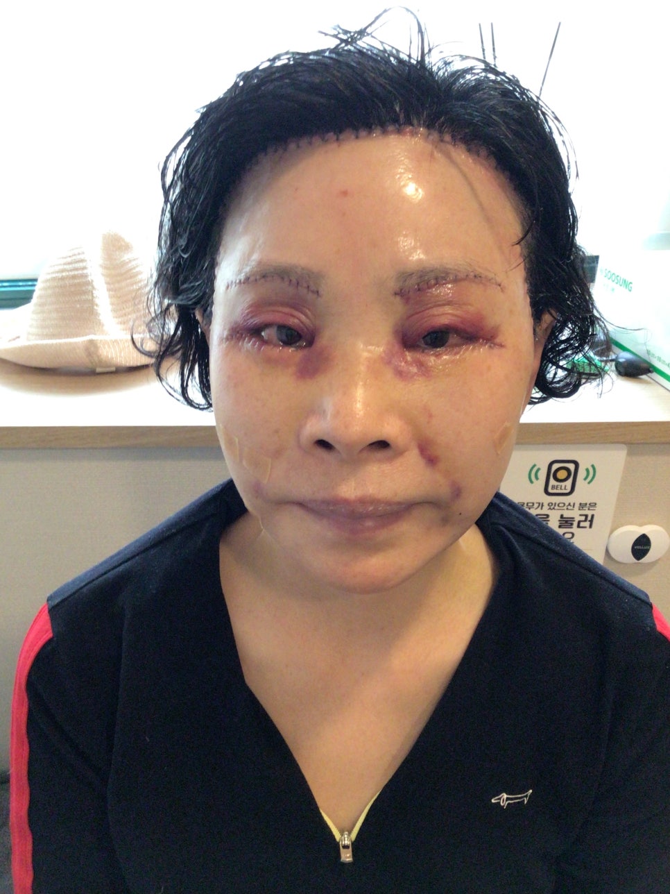 눈상담 받으러 왔다가 풀안면거상까지 하게된 60대중반 중년 어머님 (전/후) /목동 성형외과 스텔라성형 관련 이미지 16