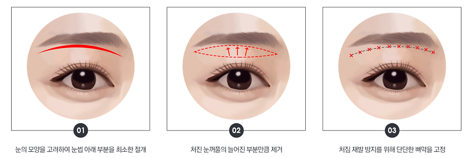 [오목교] 목동 성형외과 스텔라 직원 어머니 !! 60대 눈성형 (전/후) 관련 이미지 5