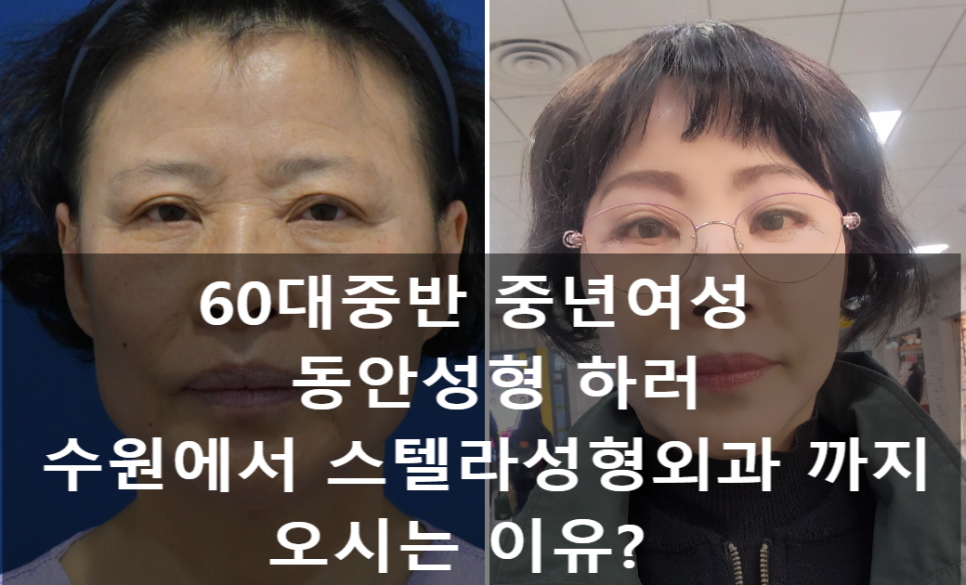 눈상담 받으러 왔다가 풀안면거상까지 하게된 60대중반 중년 어머님 (전/후) /목동 성형외과 스텔라성형 관련 이미지 24