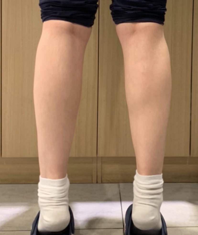 종아리 보톡스 잘하는곳 (직원후기)/나보타보톡스 관련 이미지 2