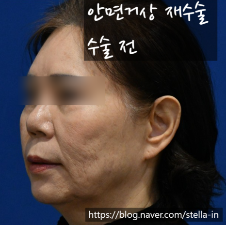 화곡동 /까치산/ 목동성형외과 (스텔라의원) 3월까지 안면거상 재수술 이벤트 비용 ? 주목! 관련 이미지 2