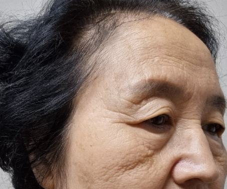 [오목교] 효도성형! 70대 어머님 ,스텔라의원에서 제 2의인생 다시시작하다! 관련 이미지 3