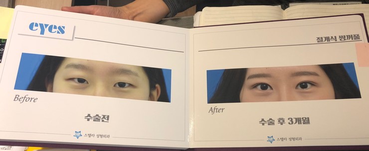눈성형 책자 제작, 양천구 성형외과 스텔라의원 관련 이미지 3